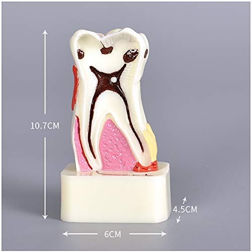 Kh66zky 4 פעמים עששת שיניים מודל דגם פתולוגיה מקיפה מודל שיניים עששת חישובים עיסת נשיכה ללבוש מצב הפגנת מצב פתולוגי